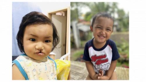Parents of cleft children share their smiling faces with Dr. Dax