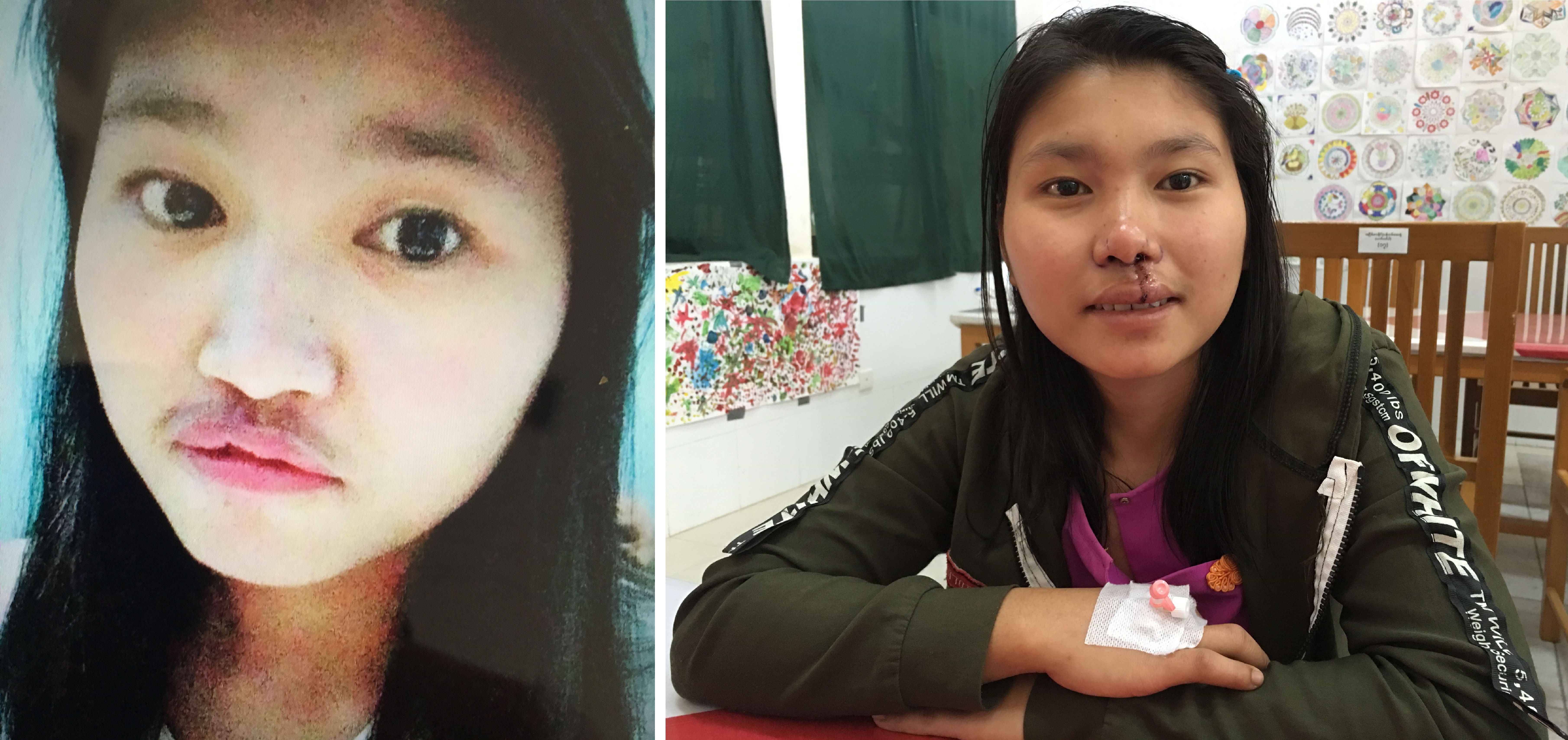 緬甸雅達娜手術前手術後。