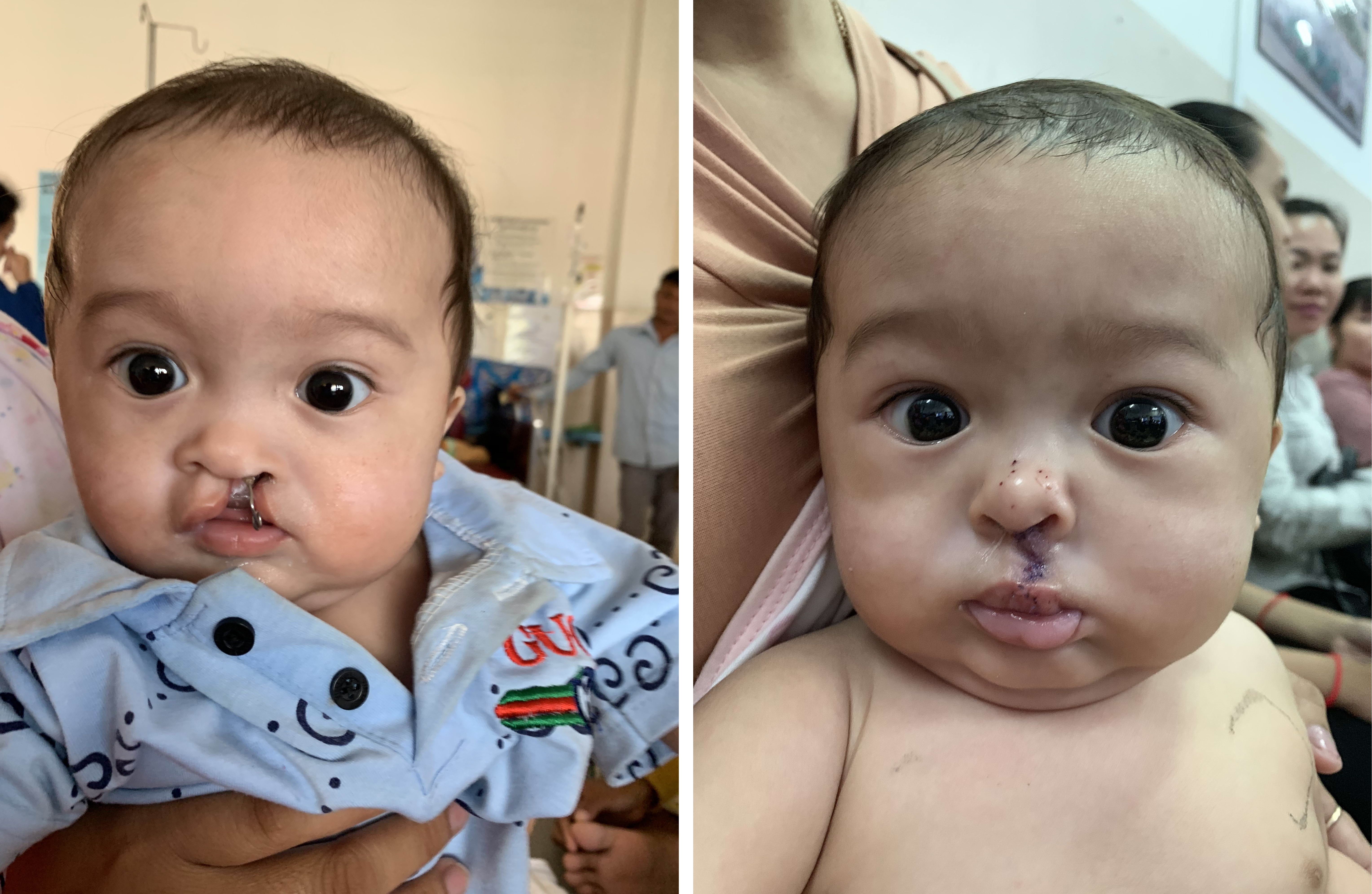 柬埔寨拉戴La Deveth手術前及手術後。