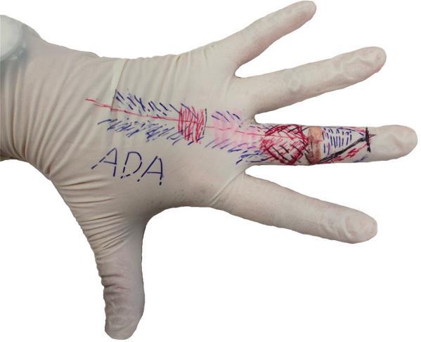 在手上畫出手指的肌肉伸展機制，學習手部復健的知識。